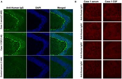 Autoantibodies against eukaryotic translation elongation factor 1 delta in two patients with autoimmune cerebellar ataxia